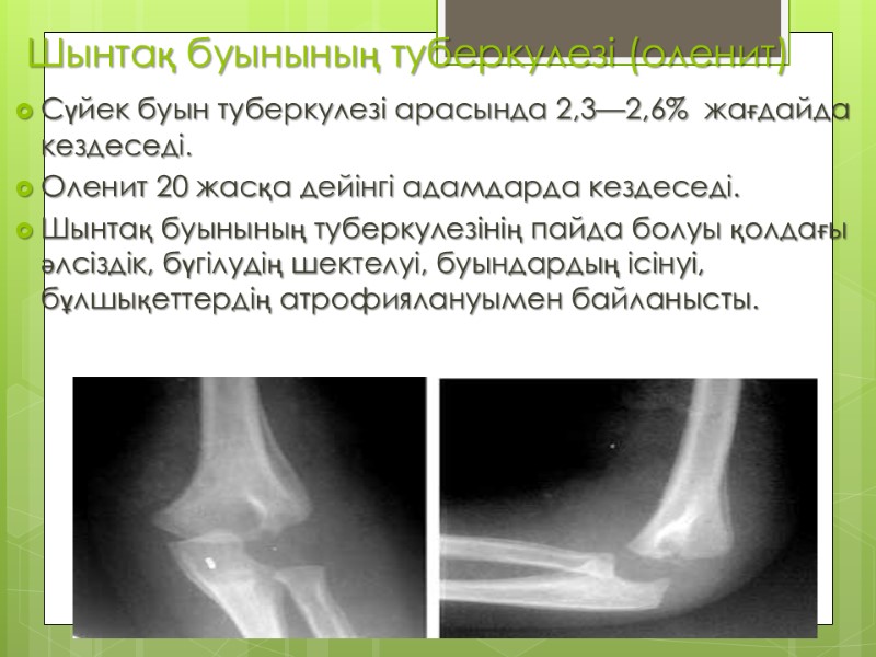 Шынтақ буынының туберкулезі (оленит)  Сүйек буын туберкулезі арасында 2,3—2,6%  жағдайда кездеседі. Оленит